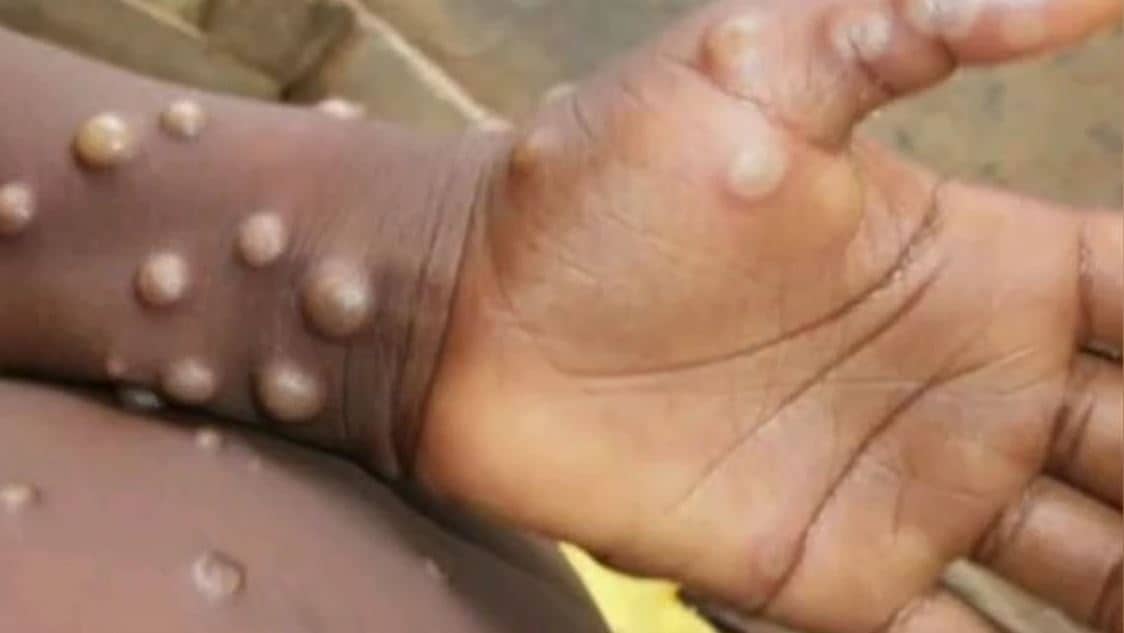 औरंगाबाद में मंकीपॉक्स ने दी दस्तक, संदिग्ध मरीज के मिलने से मचा हड़कंप