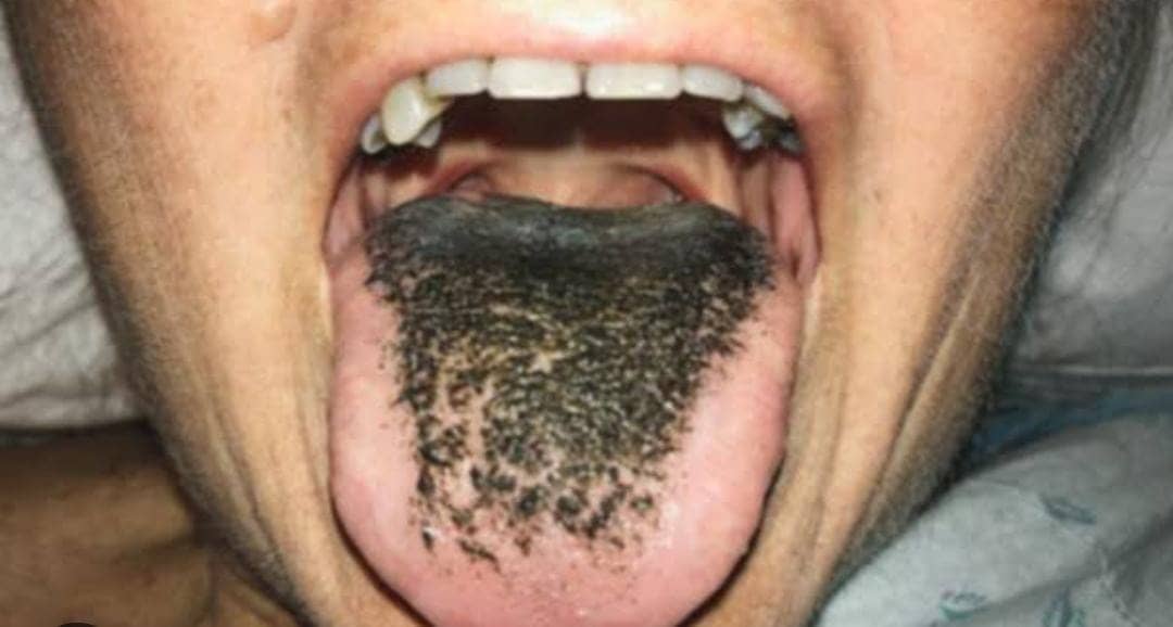 OMG ! अचानक महिला की जीभ पर निकले बाल, महिला के साथ लोग भी हैरान, जानें कैसे हुआ ये