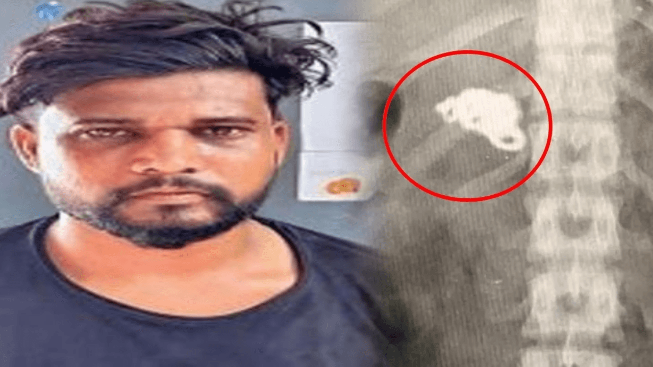 रांची: चेन निगलना स्नैचर के लिए पड़ा गया महंगा, डॉक्टरों को चेन निकालने में छूट रहें पसीने, जानिए पूरा मामला