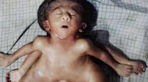चार-चार हाथ-पैरों के साथ जन्मी अजीबो-गरीब बच्ची, मिनट बाद ही तोड़ा दम, जानें क्या है डॉक्टरों की राय   