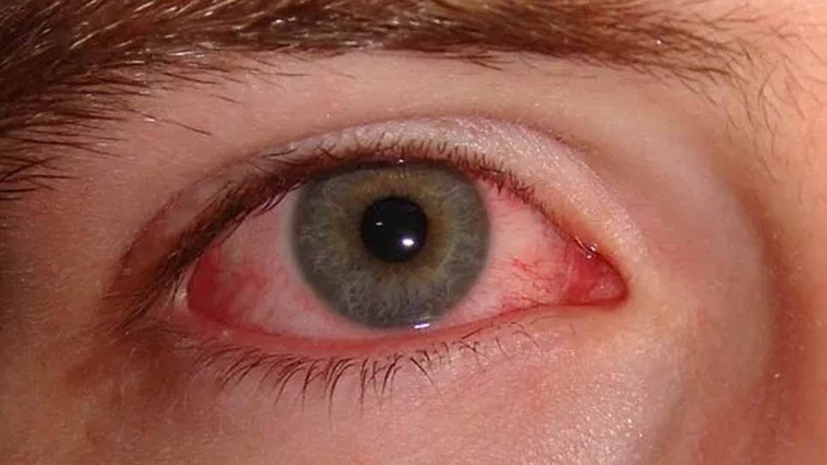 Conjunctivitis:मानसून में तेजी से फैल रहा है पिंक आई इंफेक्शन का खतरा, जानें बचाव का तरीका