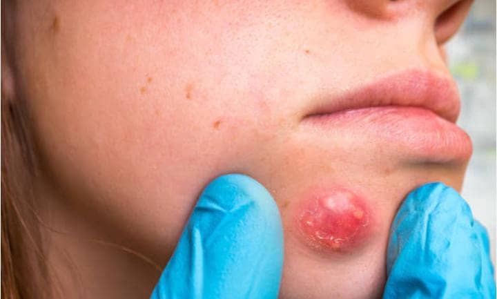 बरसात में निकले फोड़े फुंसी के दर्द से हैं परेशान, तो जरुर करें ये उपाय