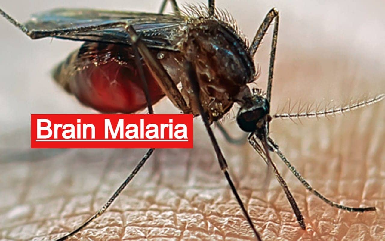 साहिबगंज में ब्रेन मलेरिया से पांच पहाड़िया बच्चों की मौत, जानिए क्या हैं इसके लक्षण और कैसे करें बचाव 