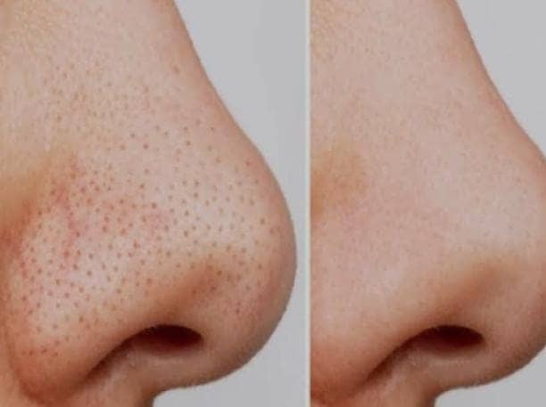 Tips And Tricks:नाक के ब्लैकहेड्स  ने छीन ली है चेहरे की रंगत, तो ना हो परेशान, अपनाएं ये घरेलू और सस्ता उपाय