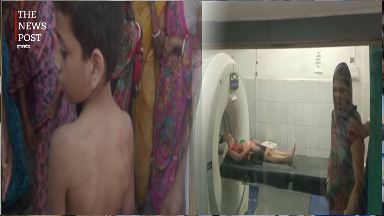 नवादा: होस्टल में छात्र की बेरहमी से पिटाई, परिजनों ने स्कूल प्रबंधन पर की कार्रवाई की मांग