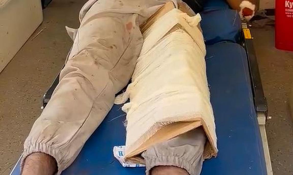 गजब हाल है भाई! एक्सीडेंट में टूटा पैर, प्लास्टर की जगह बांध दिया ये चीज़, तसवीर देख आप भी पीट लेंगे माथा