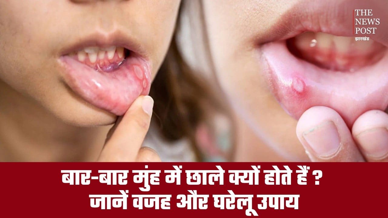 बार-बार मुंह में छाले क्यों होते हैं? जानें वजह और ठीक करने के घरेलू उपाय