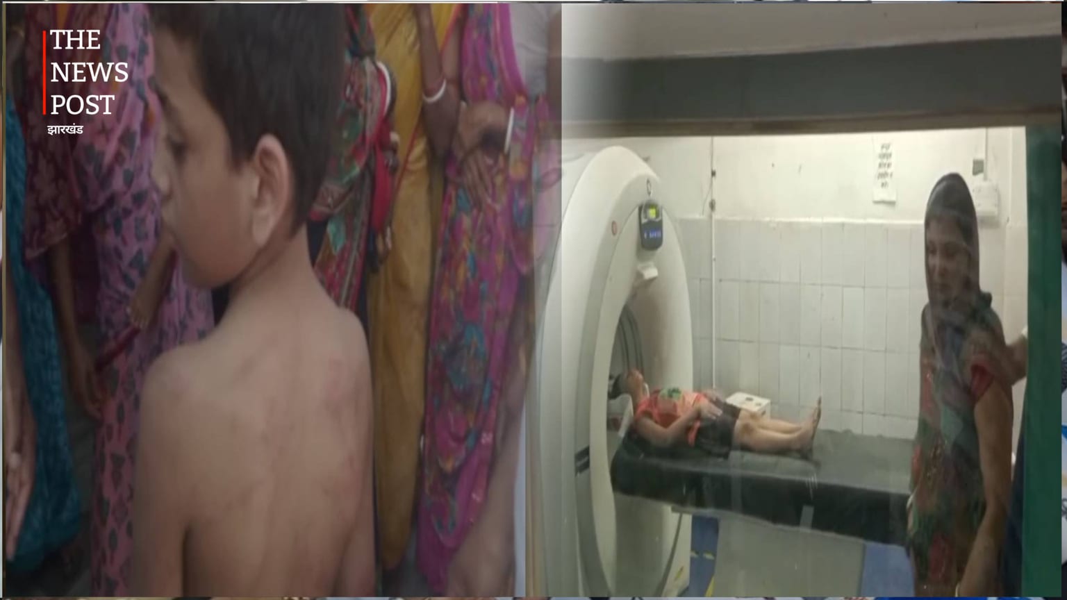 नवादा: होस्टल में छात्र की बेरहमी से पिटाई, परिजनों ने स्कूल प्रबंधन पर की कार्रवाई की मांग