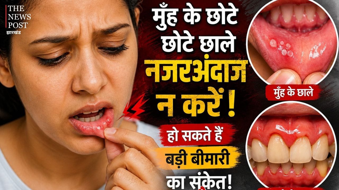 बार-बार हो रहे मुंह के छाले और मसूड़ों की सूजन को न करें नजरअंदाज, समय रहते कराएं जांच, वरना बढ़ सकती है परेशानी