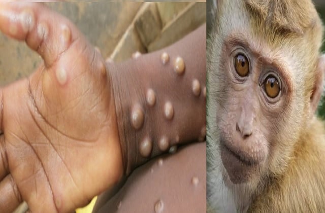 मंकीपाक्स को लेकर स्वास्थ्य विभाग ने किया एलर्ट, इलाज की व्यवस्था करने का निर्देश