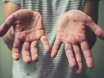 राहत: झारखंड में  मंकीपॉक्स पीड़ित बच्ची की टेस्ट रिपोर्ट आयी निगेटिव