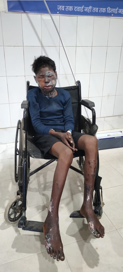 पलामू: डालटनगंज रेलवे स्टेशन पर सोए युवक पर एसिड अटैक, गंभीर स्थिति में एमआरएमसीएच में भर्ती