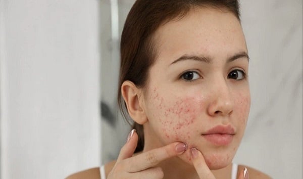 चेहरे की पिंपल्स और दाग से हैं परेशान ! इस खबर में मिलेगा सटीक समाधान