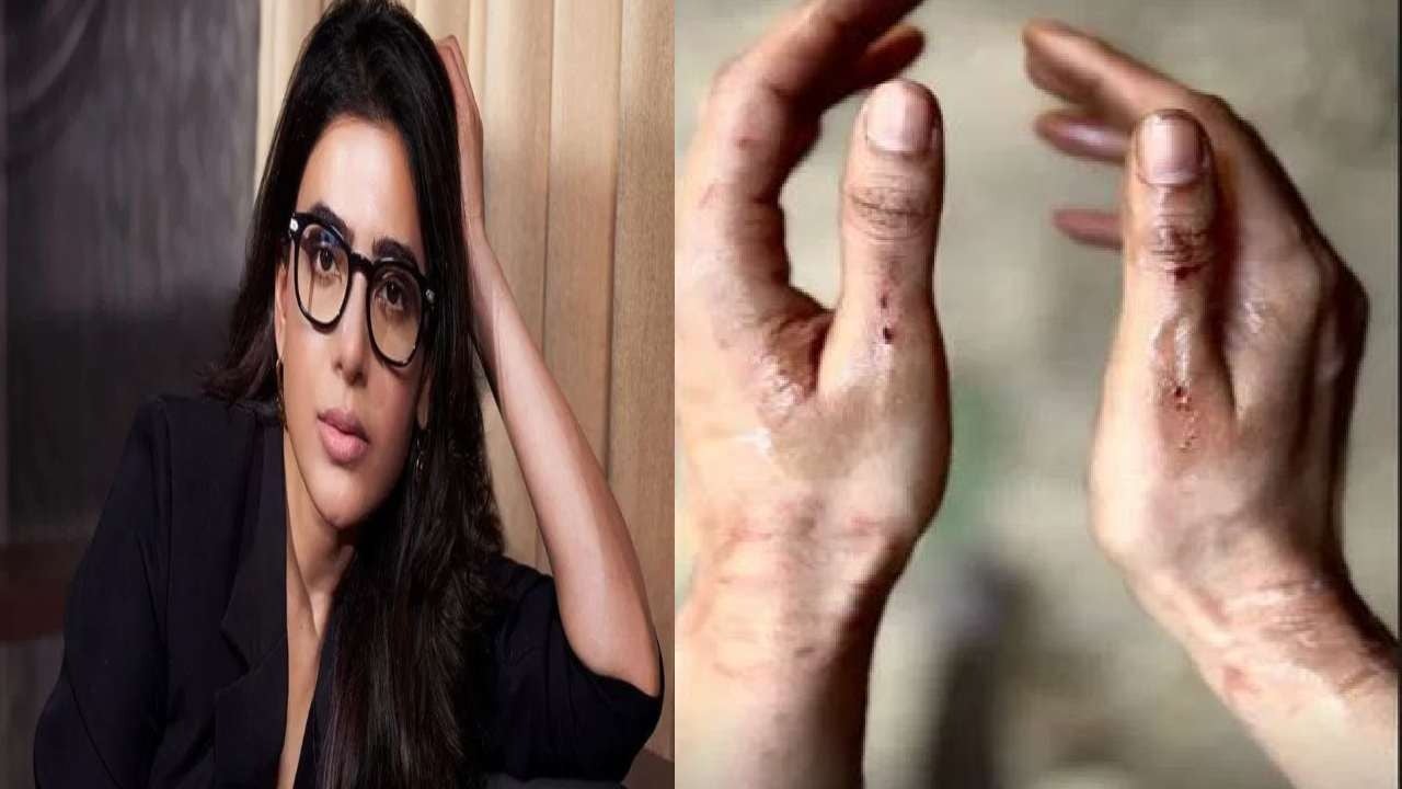 शूटिंग के दौरान साउथ ऐक्ट्रिस सामंथा हुई घायल, लोगों के साथ शेयर की तस्वीर