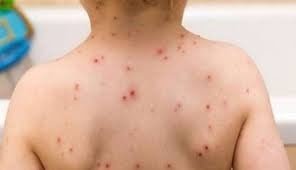 WHO की रिपोर्ट के बाद झारखंड में हड़कंप, मुंबई के बाद झारखंड में मिले खसरा का मामला, एक ही परिवार के तीन बच्चों की हुई मौत