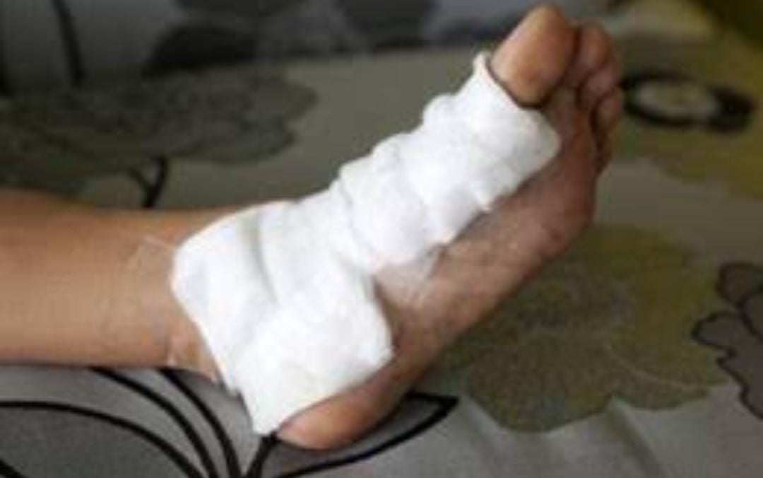 पैसे छीनकर भागे झपटमार का टूटा पैर, लोगों ने दबोचा, जाने क्या हुआ उसका हाल