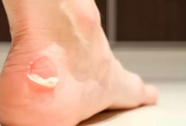 Shoe Bite Remedies: फुटवियर की वजह से पैरों में पड़ गये है छाले, तो करें ये उपाय, मिलेगी राहत