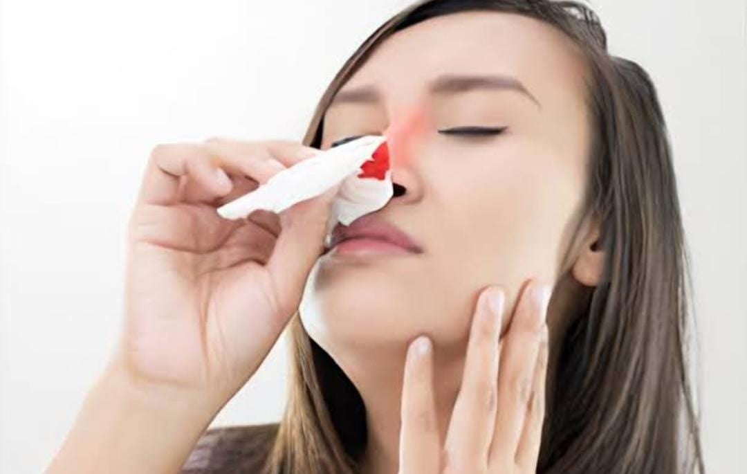 Health Post: गर्मियों में अचानक नाक से होने लगे ब्लीडिंग, तो अपनायें ये घरेलू नुस्खे, मिलेगी नकसीर से राहत