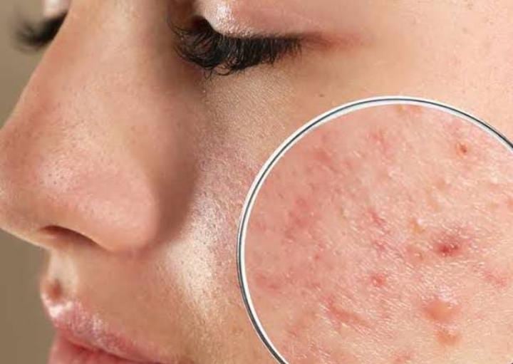 30 की उम्र में भी एक्ने की समस्या नहीं छोड़ रही है पीछा, तो अपनाएं  ये चार घरेलू तरीका,चेहरे की फोड़े फुंसी से मिलेगी निजात