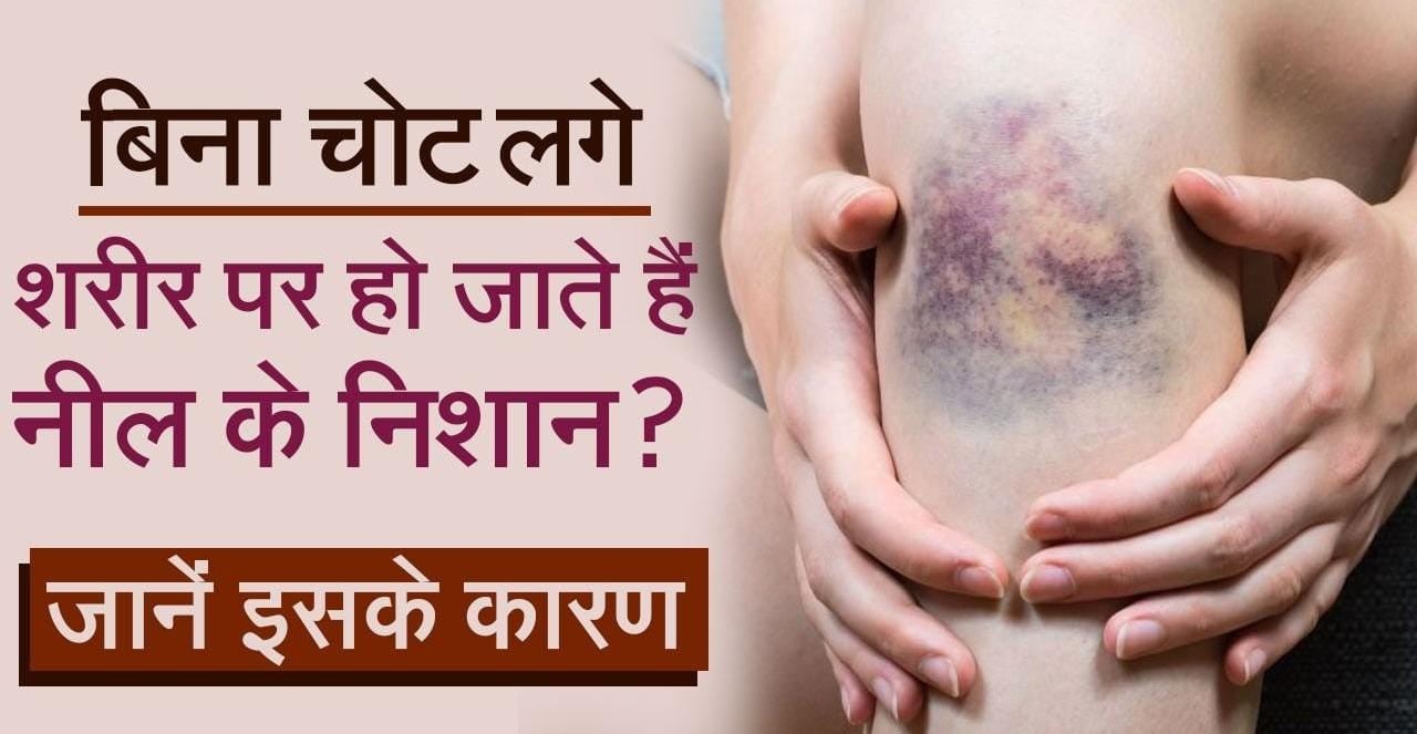 Health Alert: अगर आपके स्किन पर भी नजर आते हैं नीले निशान तो हो जाएं सावधान, इन बीमारियों के हो सकते हैं संकेत