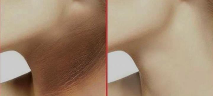 Tips And Tricks:गर्दन के कालेपन से हो रही है शर्मिदगी, तो अपनाएं दादी मां के ये नुस्खे, दिखेगा चमत्कारी असर