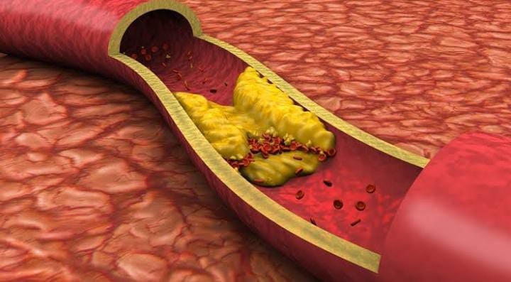 चेहरे की रंगत उड़ा देता है हाई कोलेस्ट्रोल, यदि दिखने लगे ये लक्षण तो भूलकर ना करें इग्नोर