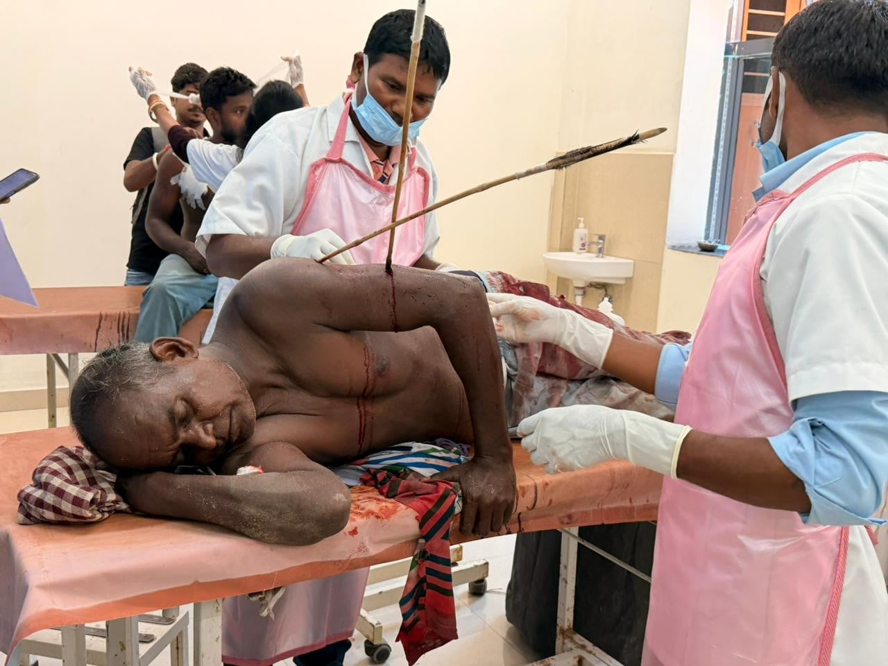 चाईबासा में सनसनी! हाट जा रहे व्यक्ति को तीर मारकर किया घायल