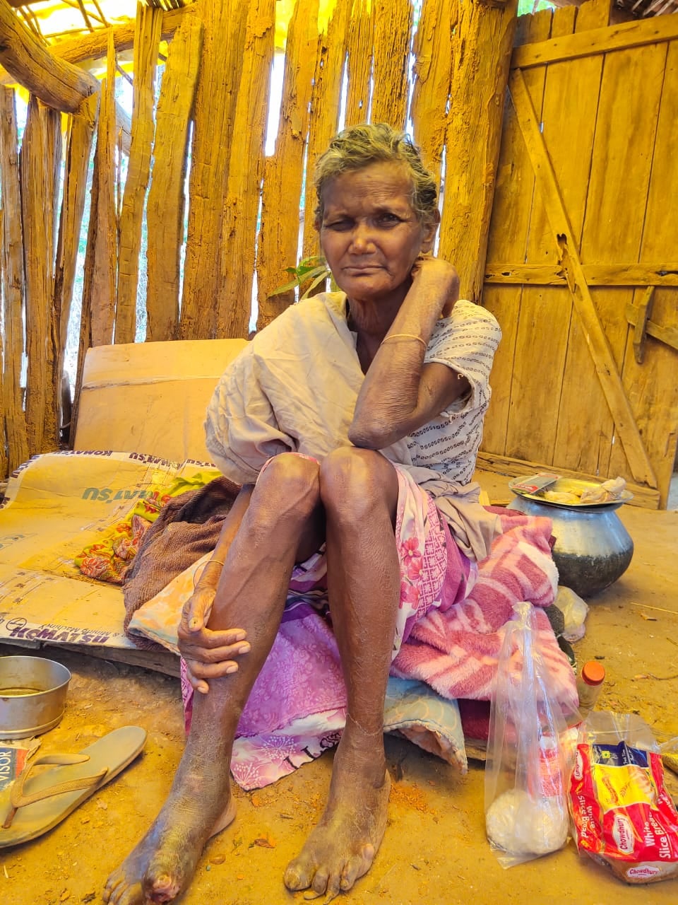 सारंडा में दर्जनों लोगों में कुष्ठ रोग के प्रारंभिक लक्ष्ण मिले, एक महिला में रोग की पुष्टि