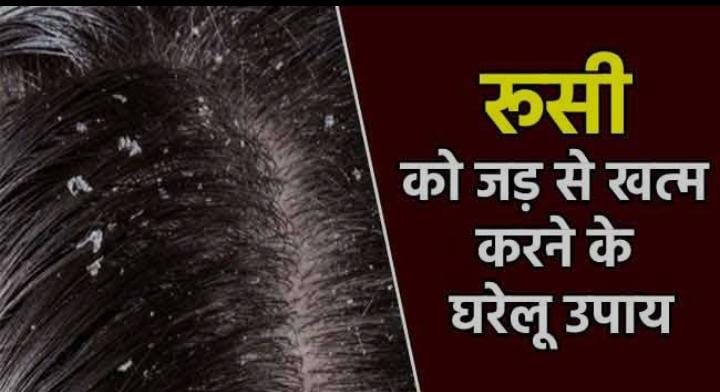 सर्दियों में डैंड्रफ की समस्या कर रही है परेशान तो अपनाएं ये 5 घरेलू उपाय