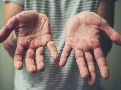 राहत: झारखंड में मंकीपॉक्स पीड़ित बच्ची की टेस्ट रिपोर्ट आयी निगेटिव