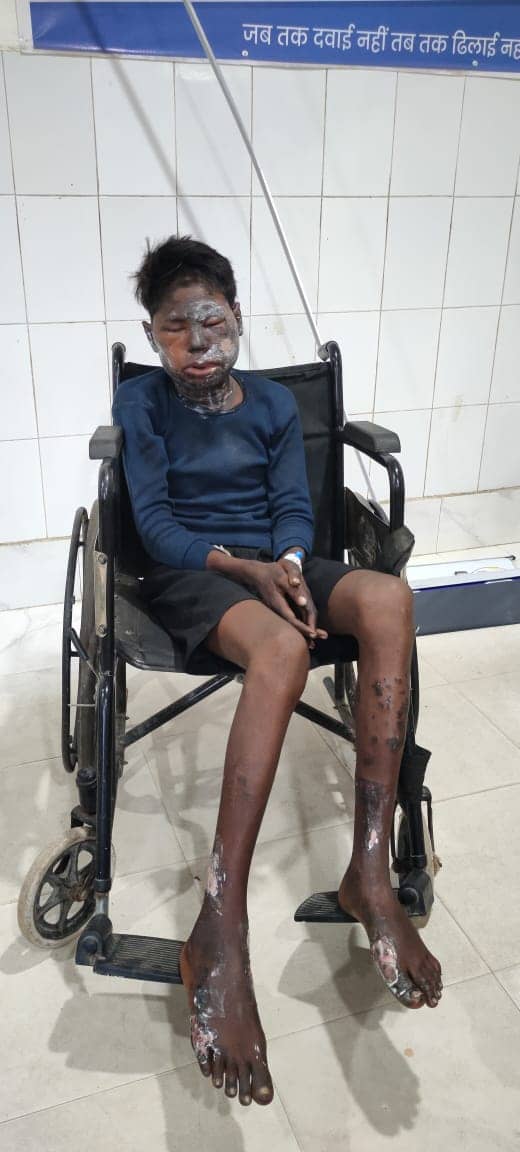 पलामू: डालटनगंज रेलवे स्टेशन पर सोए युवक पर एसिड अटैक, गंभीर स्थिति में एमआरएमसीएच में भर्ती