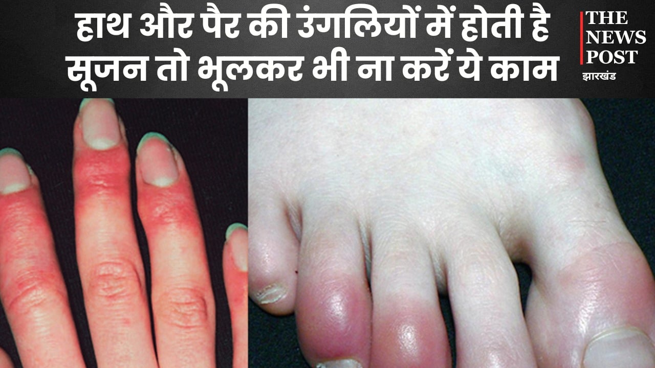 सर्दियों में हाथ-पैर की उंगलियों में क्यों आ जाती है सूजन, जानें ठीक करने के क्या हैं घरेलू उपचार