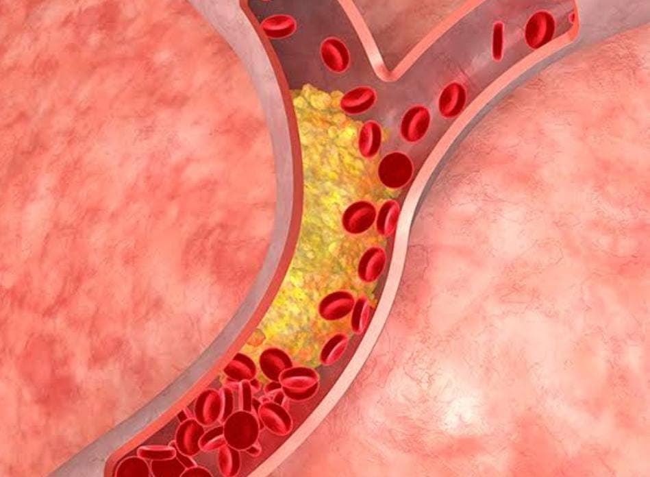 आपके शरीर को खोखला कर देगा हाई कोलेस्ट्रॉल, साइलेंट किलर की तरह करता है काम, करें ये उपाय